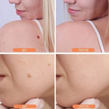 Косметологический аппарат OLLO Store Плазменная ручка (Mole Freckle Removal Pen) для удаления бородавок и папиллом с электронным дисплеем и с аккумулятором